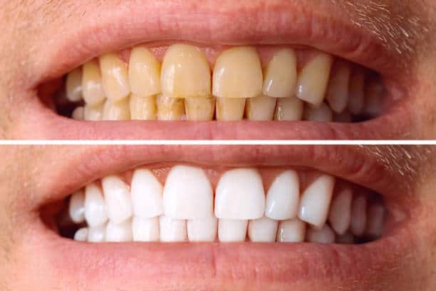 Laser White For Ever Bright – Get a Brighter, Whiter Smile with LA Teeth Whitening Colchester