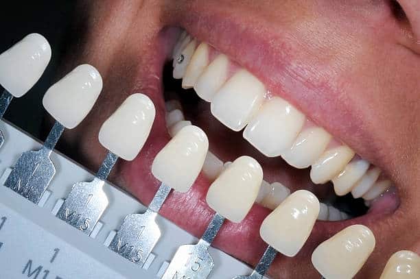 Get Natural and Stunning Smile with Teeth Whitening Results from LA Teeth Whitening Colchester