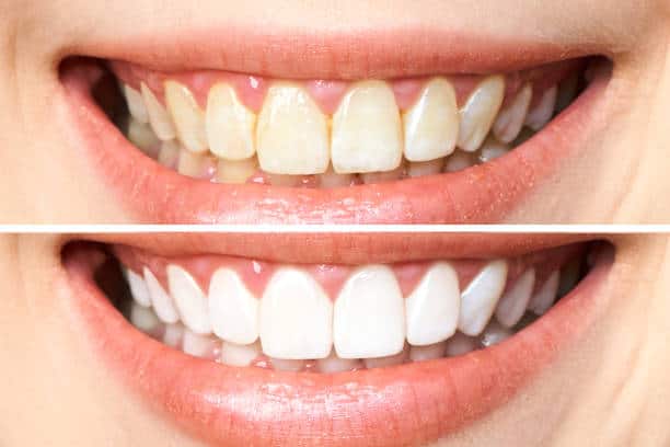 Achieve a Dazzling Smile for Your Special Day: A Guide to Wedding Teeth Whitening Colchester