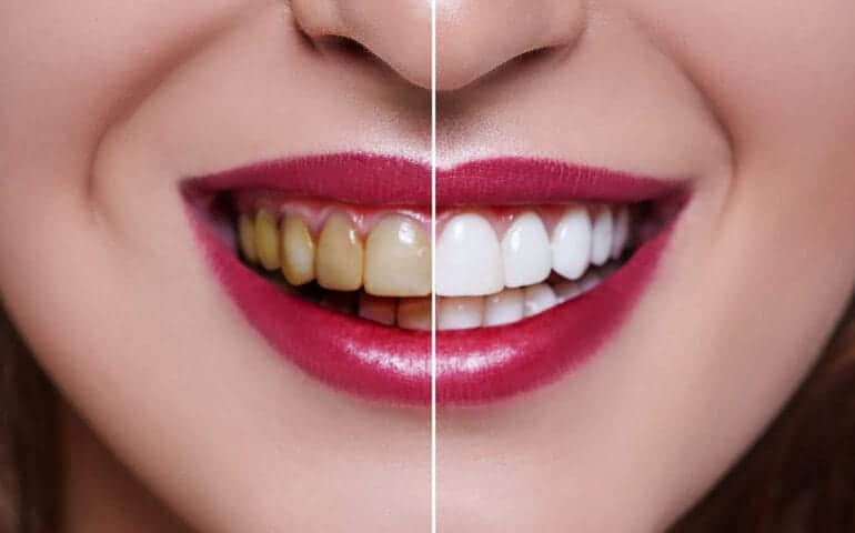 Teeth Whitening Ascot Windsor Colchester