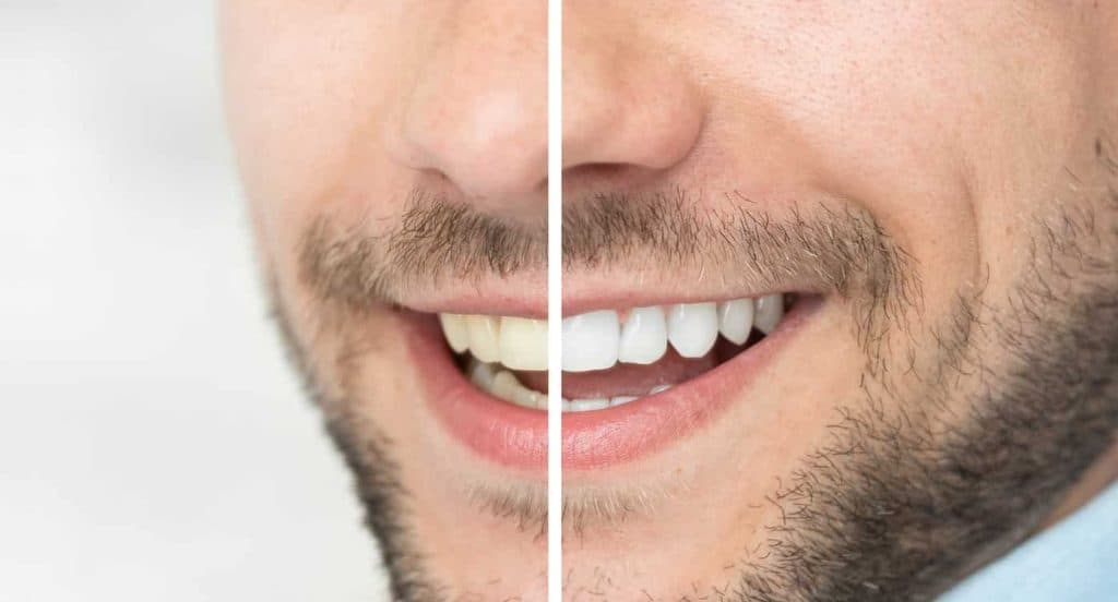 Teeth Whitening Bedfordshire Colchester