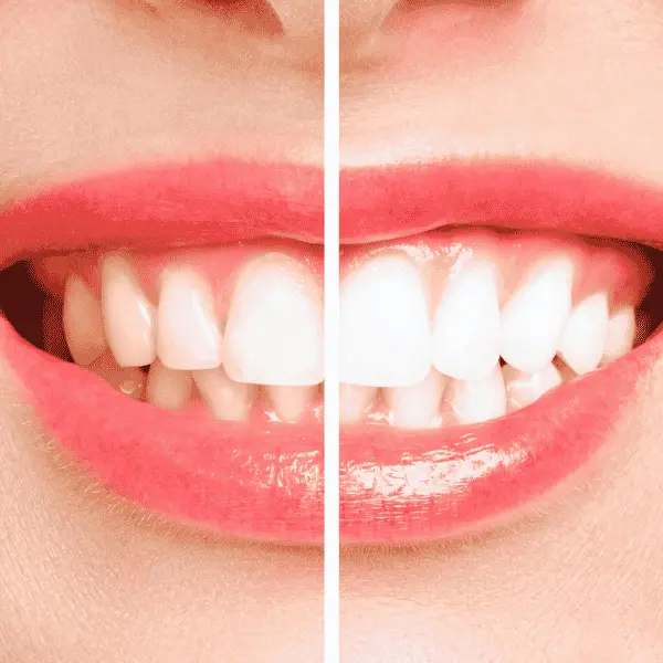 Fast teeth whitening Colchester book in today! Colchester