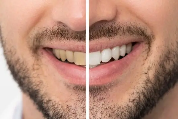 A whiter smile in just 1 hour with Blue light teeth whitening Hertfordshire! Colchester